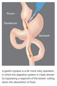 Gastric bypass