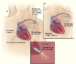 Pacemaker implantation