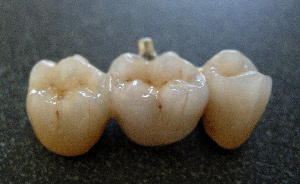 Dental bridges