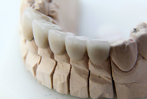Dental crowns