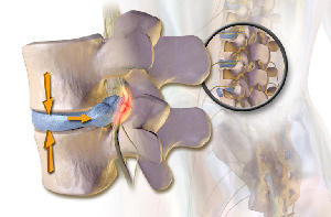 Herniated disc treatment
