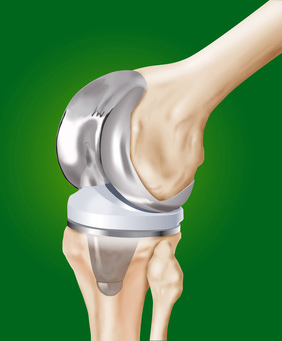Knee replacement surgery
