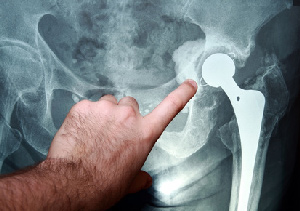Hip Endoprosthesis