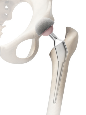 Hip resurfacing