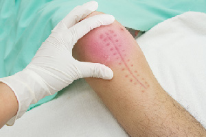 Knee replacement surgery