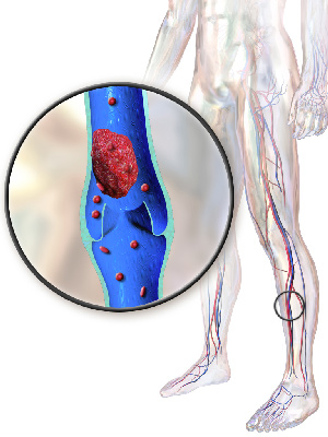 Vein thrombosis treatment