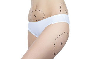 Liposuction in Germany