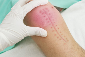 Surgery scar treatment