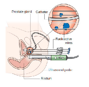 Brachytherapy